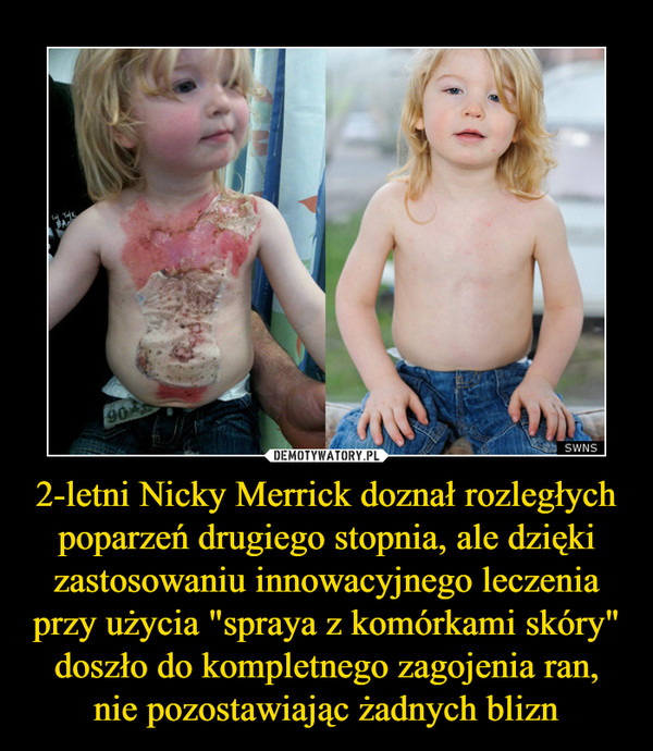 2-letni Nicky Merrick doznał rozległych poparzeń drugiego stopnia, ale dzięki zastosowaniu innowacyjnego leczenia przy użycia "spraya z komórkami skóry" doszło do kompletnego zagojenia ran, nie pozostawiając żadnych blizn