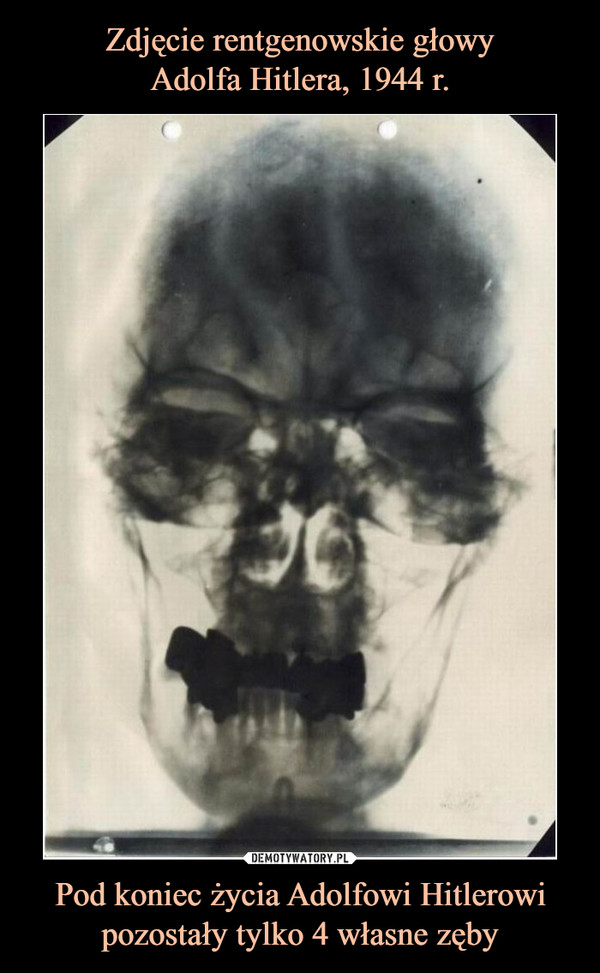 Zdjęcie rentgenowskie głowy
Adolfa Hitlera, 1944 r. Pod koniec życia Adolfowi Hitlerowi pozostały tylko 4 własne zęby