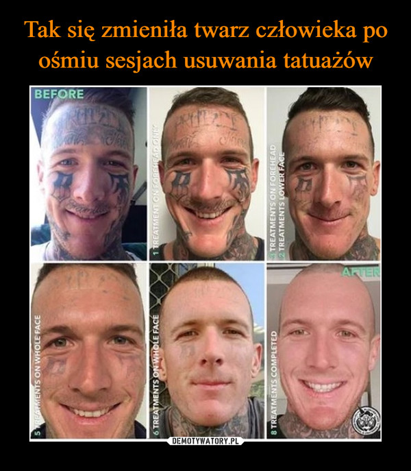 Tak się zmieniła twarz człowieka po ośmiu sesjach usuwania tatuażów