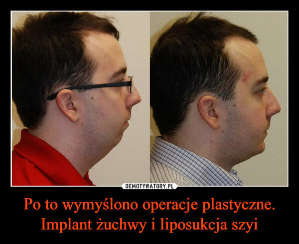 Po to wymyślono operacje plastyczne.Implant żuchwy i liposukcja szyi –  