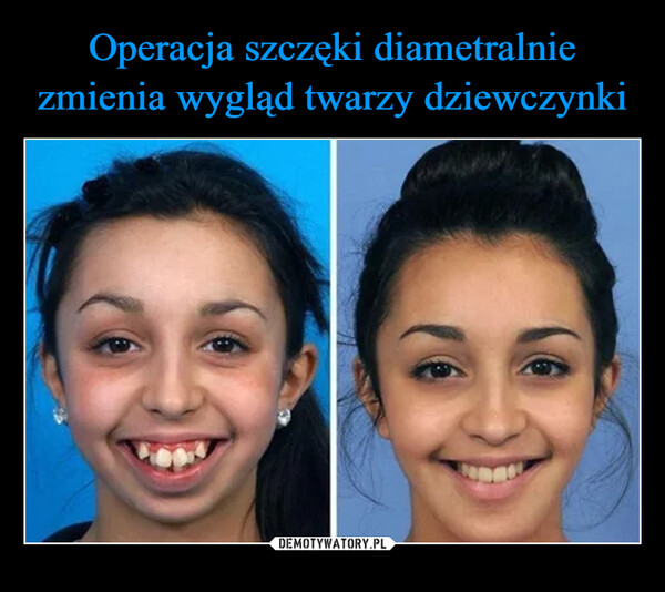 Operacja szczęki diametralnie zmienia wygląd twarzy dziewczynki
